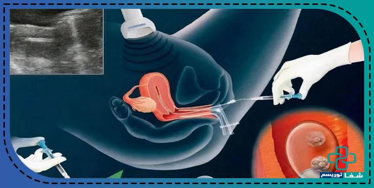 IVF 3